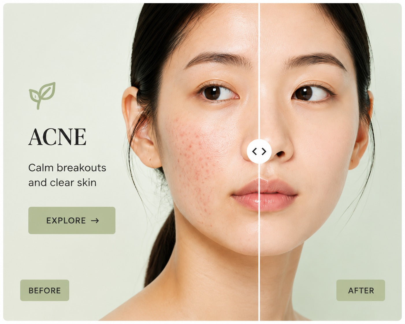 Acne